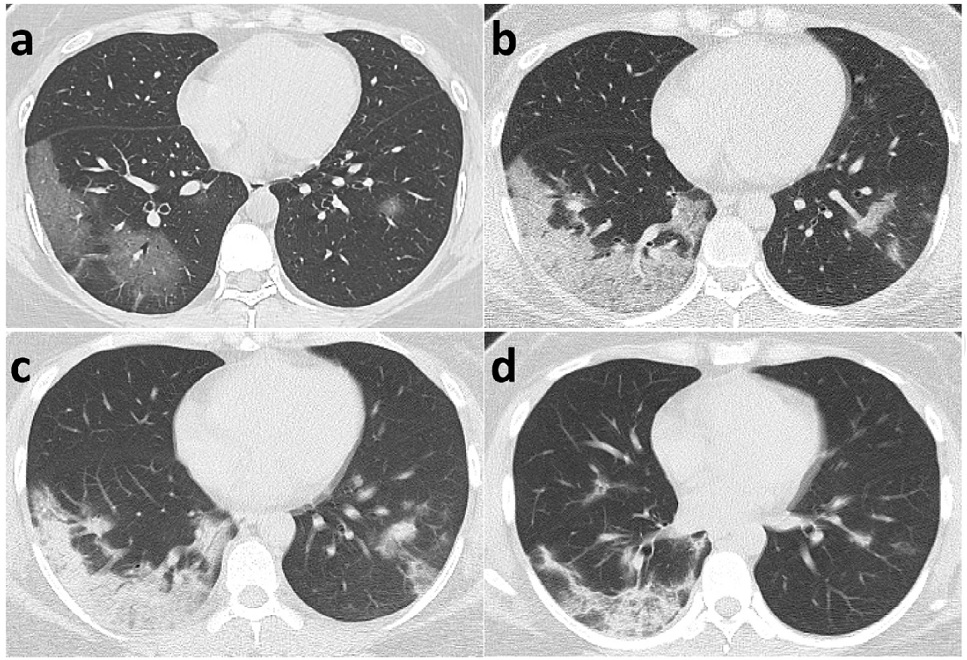 CT pattern of resolution over time Wang et al Radiol in press